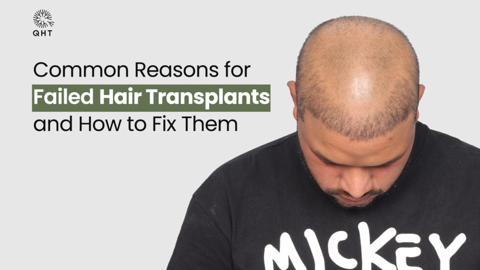 Common Reasons for Failed Hair Transplants and How to Fix Them