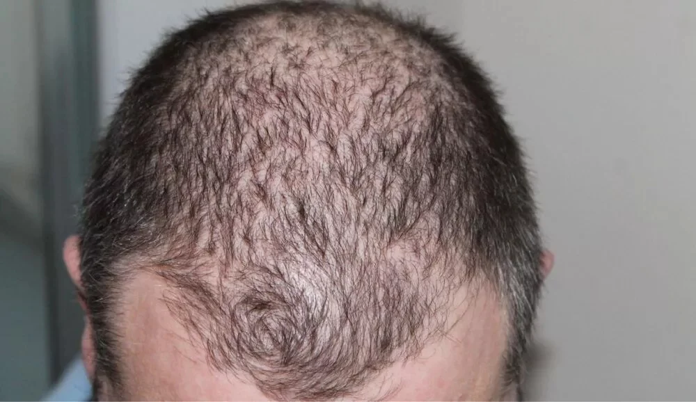 Case Study for Grade7 Hair Loss and Treatment