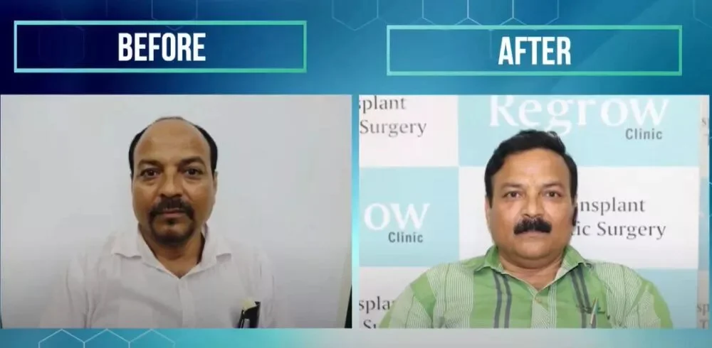 Excessive Baldness and Hair loss Treated with FUE Hair Transplant