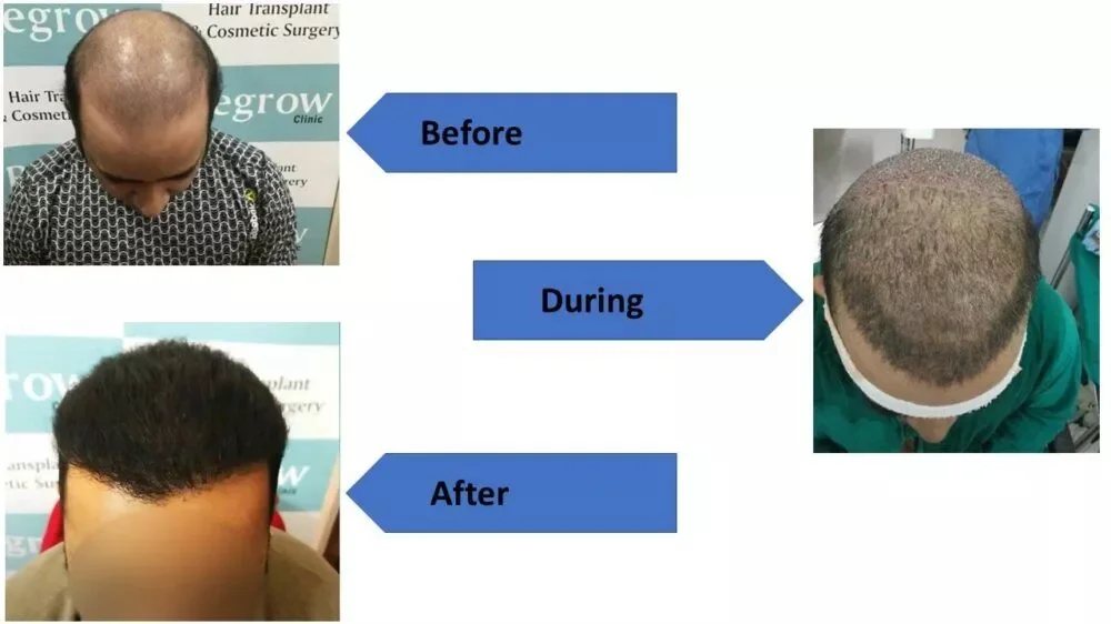 Grade 7 Baldness Treated with FUE Hair Transplant