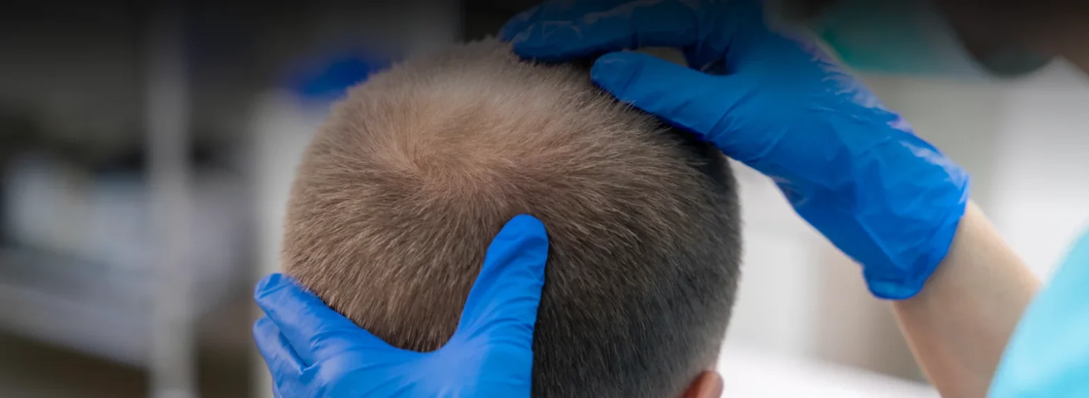 The Global Leaders in Hair Transplant