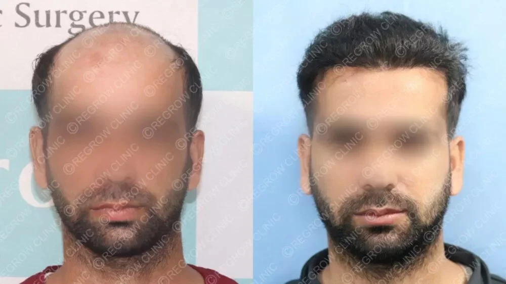 Best Hair Transplant Result 2021 || NW Grade VI || 4,975 Grafts || QHT Clinic Haridwar