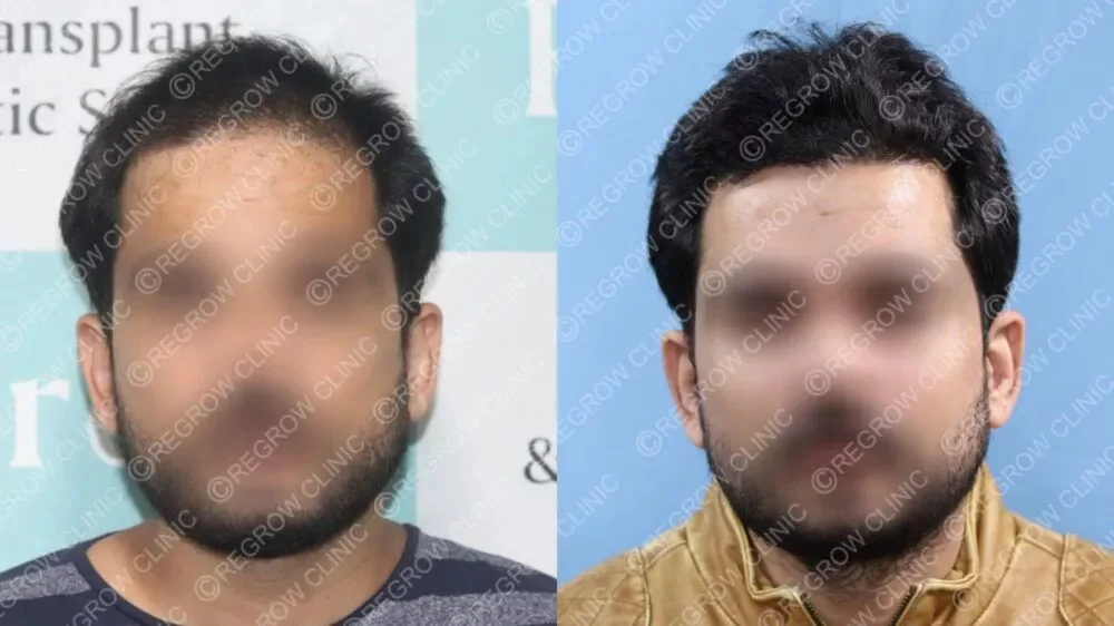 Best Hair Transplant Result 2021 || NW Grade II || QHT || 2,370 Grafts |