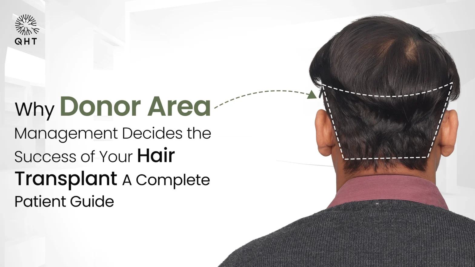 Why Donor Area Management Decides the Success of Your Hair Transplant: A Complete Patient Guide