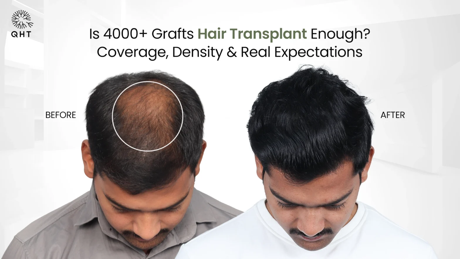 Is 4000+ Grafts Hair Transplant Enough? Coverage, Density & Real Expectations