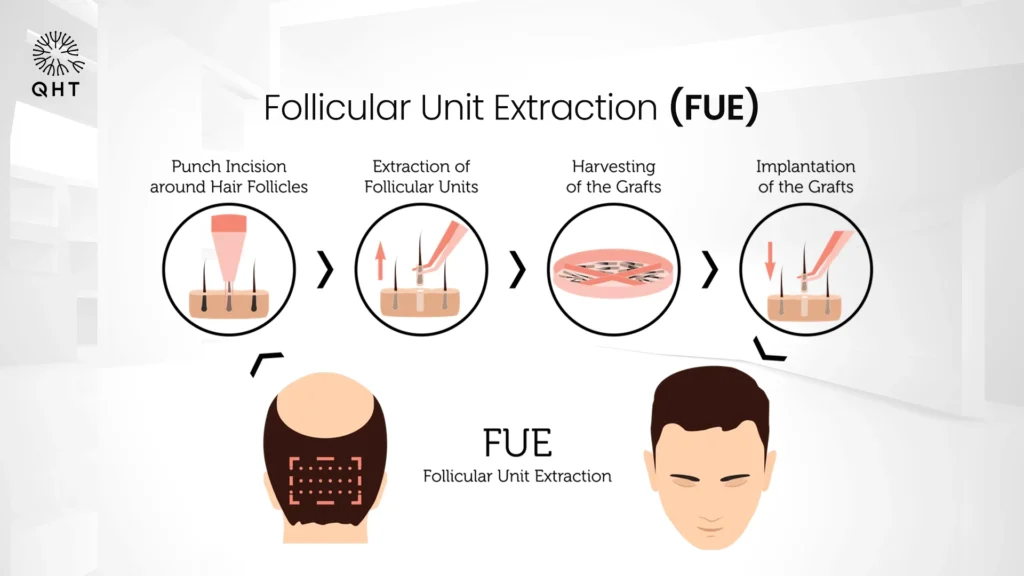 Detailed infographic explaining the four steps of Follicular Unit Extraction (FUE): punch incision, extraction, harvesting, and implantation of hair grafts.