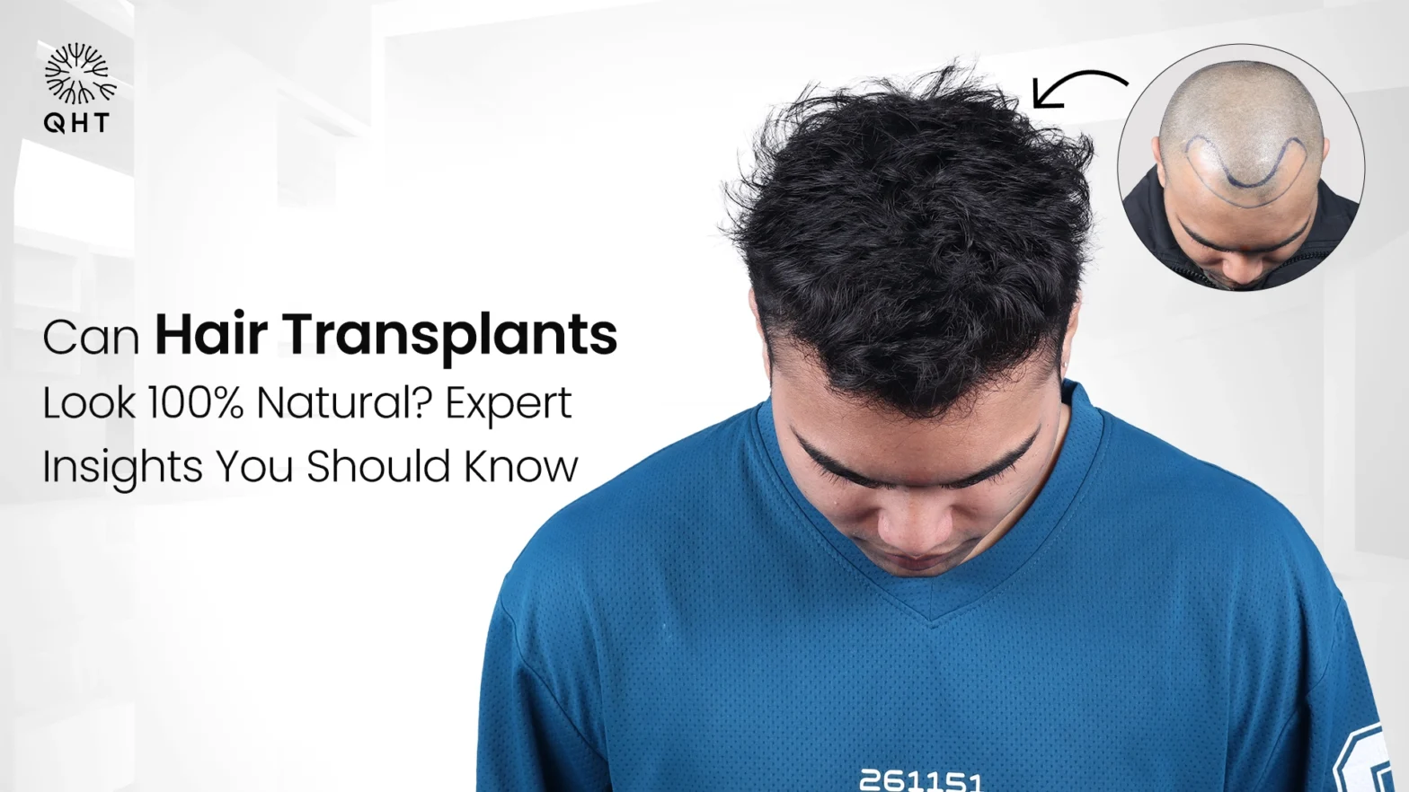 Can Hair Transplants Look 100% Natural? Expert Insights You Should Know