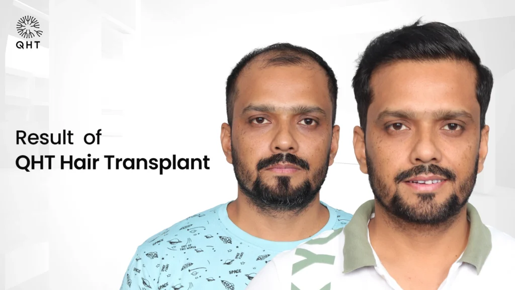 Male patient's before and after photo showing successful QHT hair transplant and hair restoration