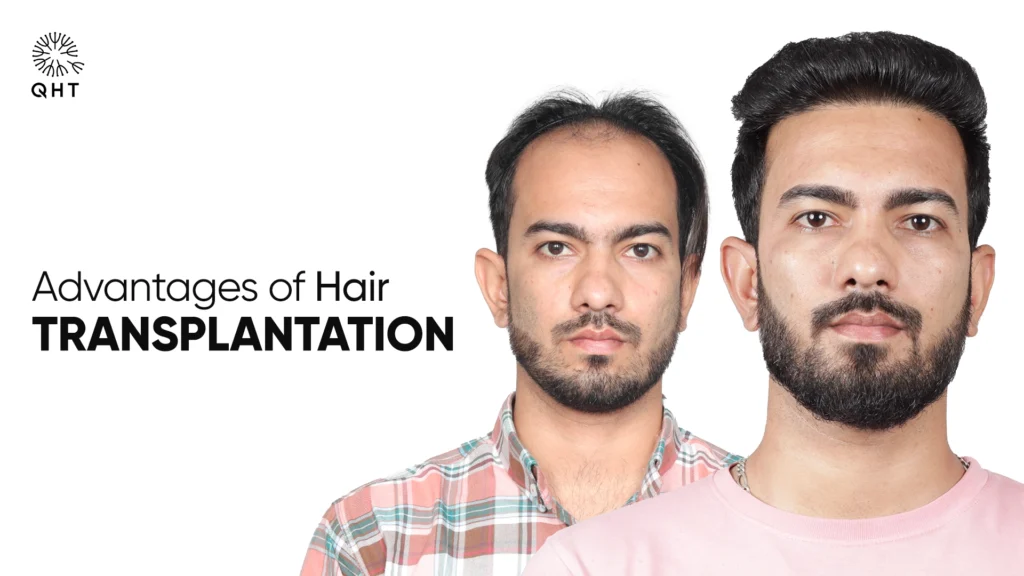 Before-and-after image showing the advantages of hair transplantation, with a man on the left having a receding hairline and the same man on the right with a full, natural head of hair.
