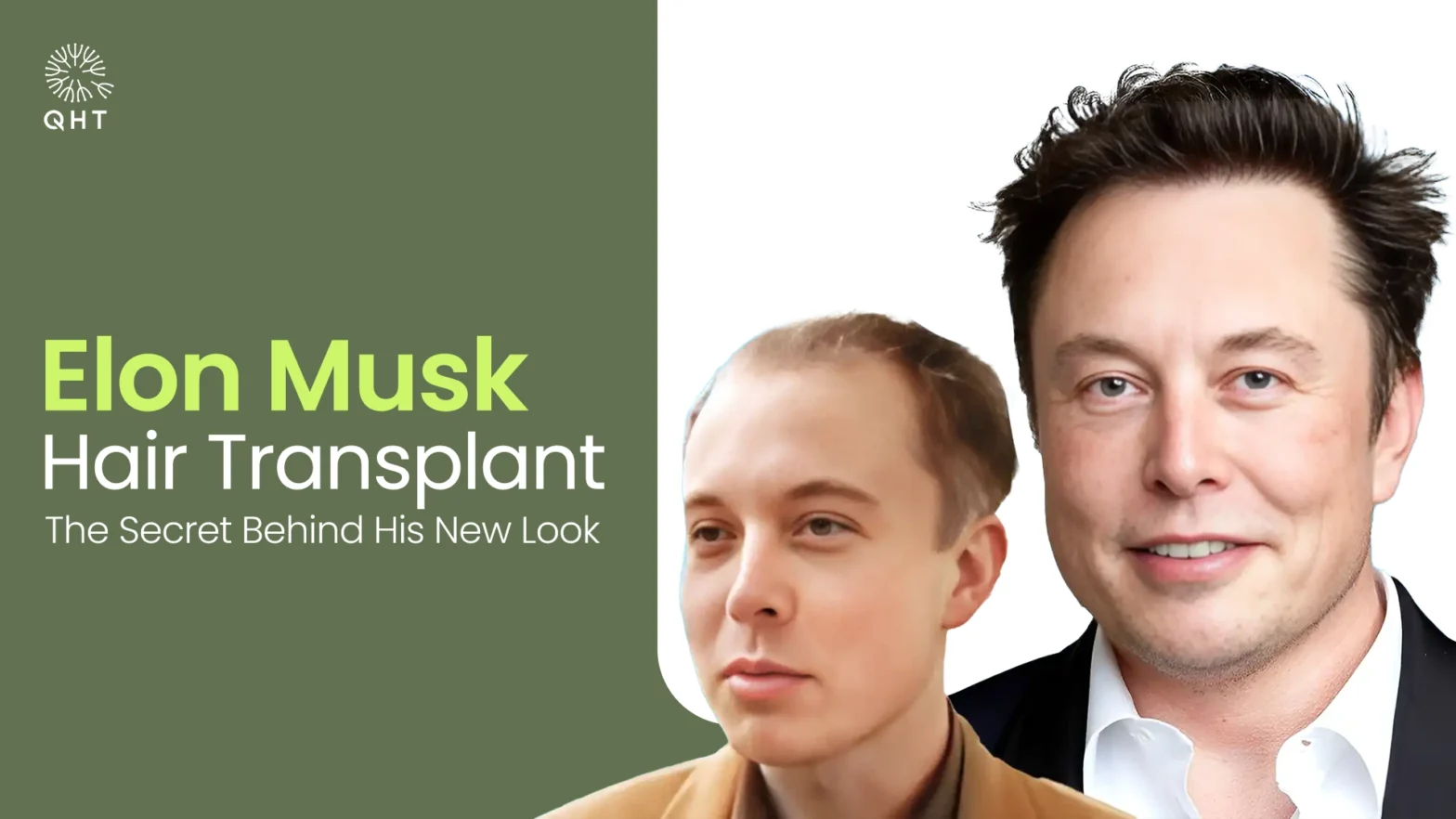 Elon Musk Hair Transplant: The Secret Behind His New Look