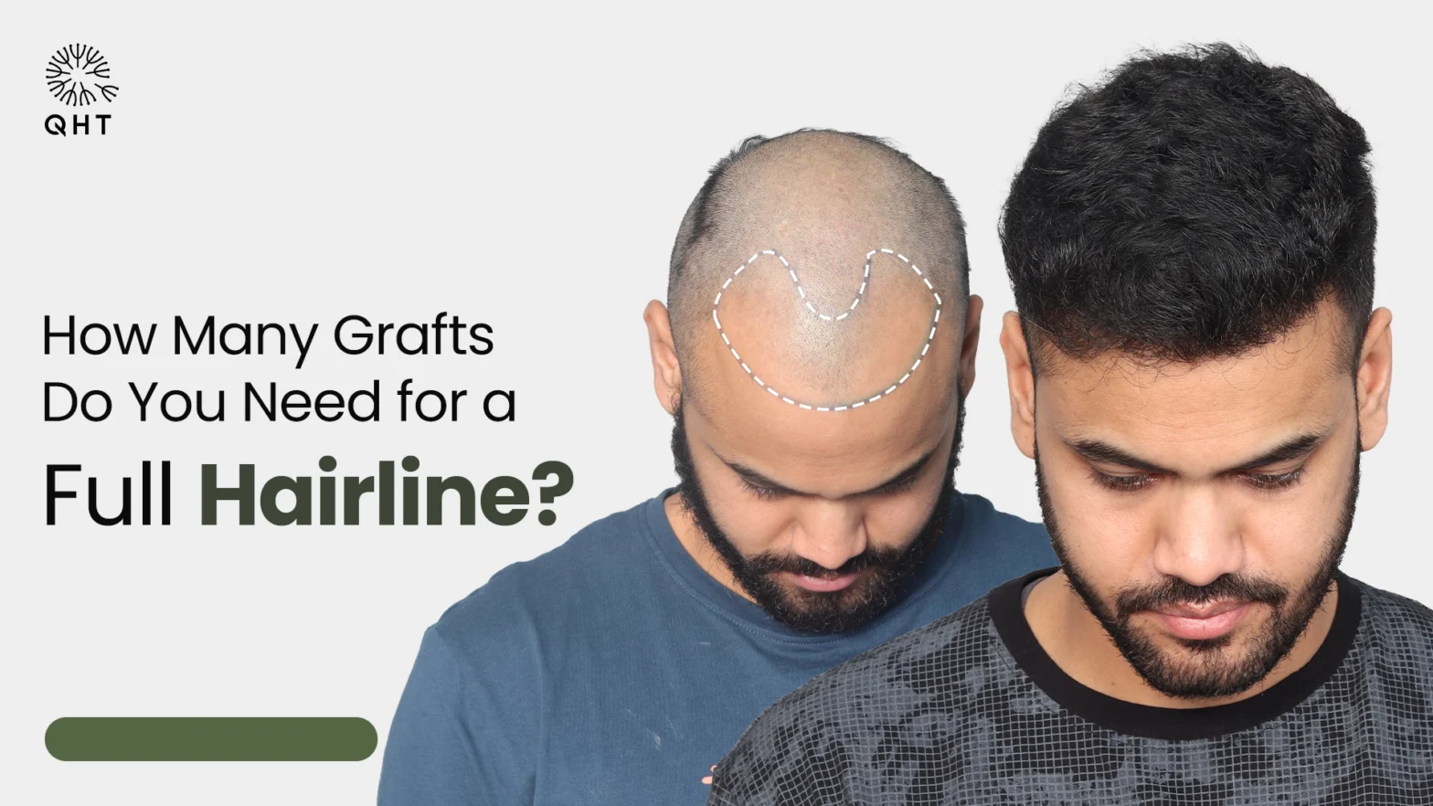 How Many Grafts Do You Need for a Full Hairline?