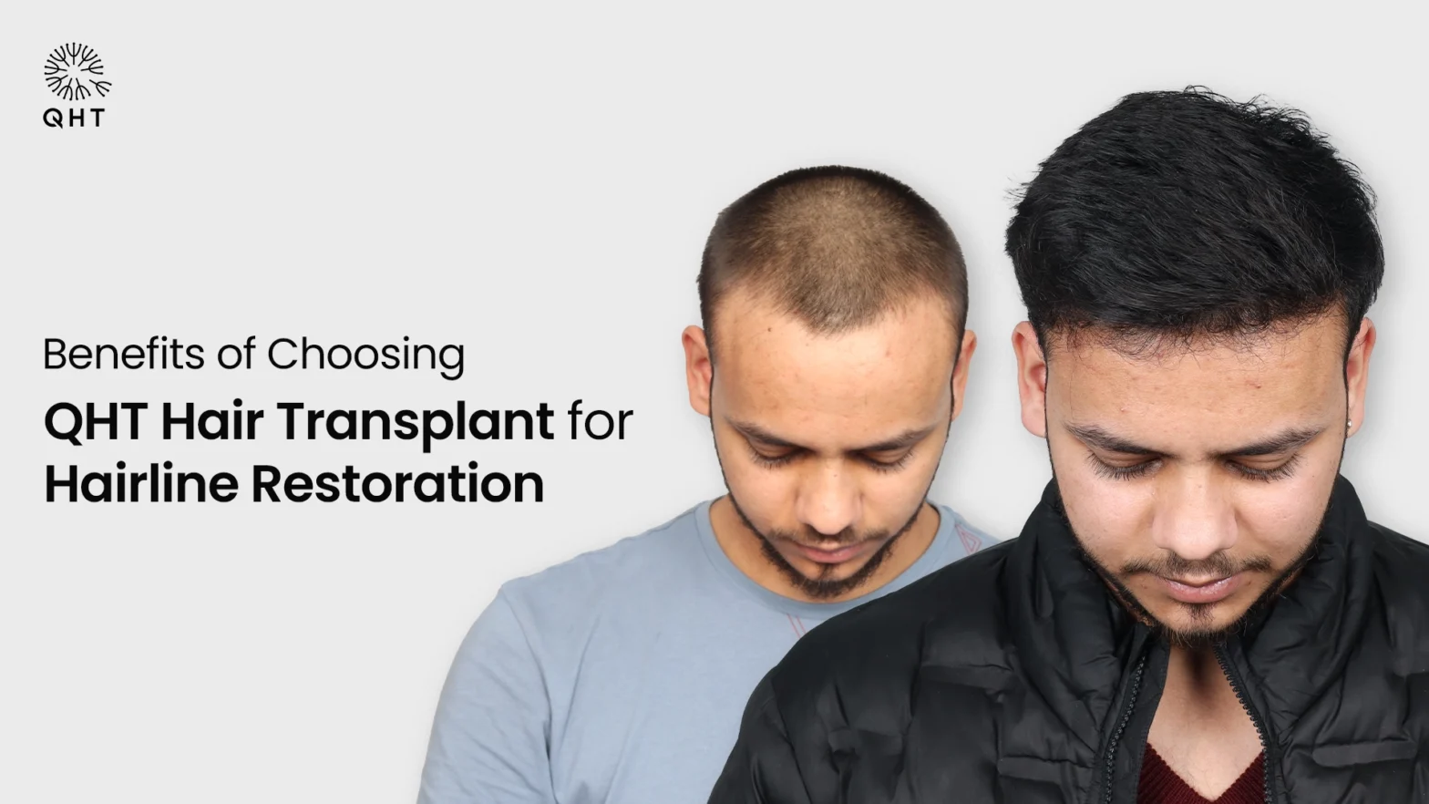 Benefits of Choosing QHT Hair Transplant for Hairline Restoration