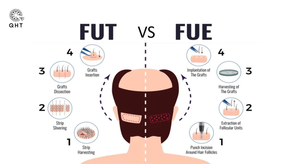 A medical infographic comparing the 4-step processes of FUT (strip method) and FUE (follicular unit extraction) hair transplants at QHT Clinic.