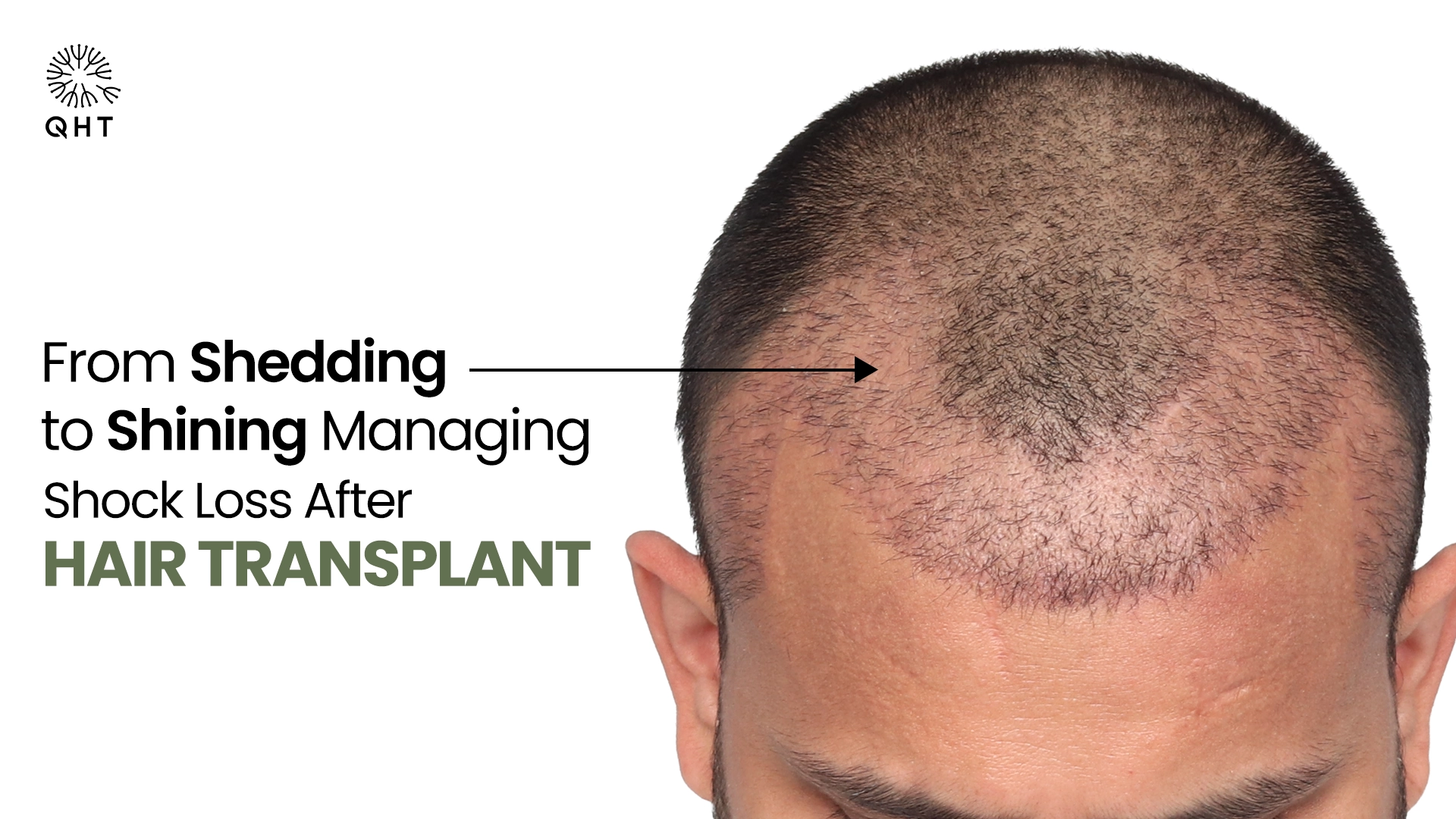 Shock Loss After Hair Transplant: Recovery & Timeline Guide